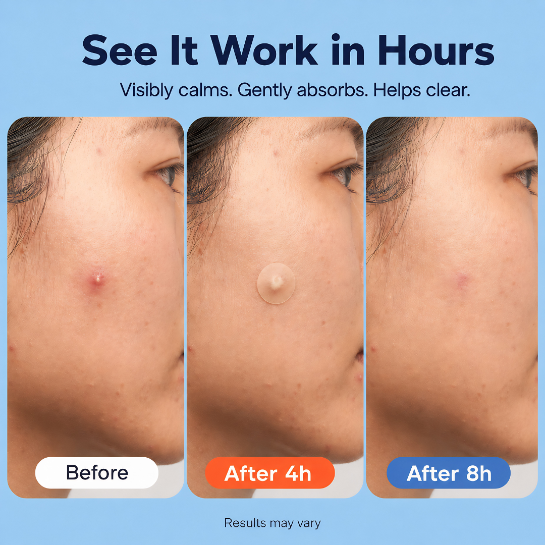 Amure™ 609 Count Hydrocolloid Pimple Patches for All Skin Types