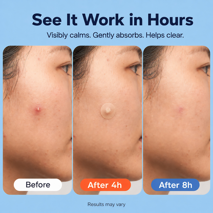 Amure™ 609 Count Hydrocolloid Pimple Patches for All Skin Types